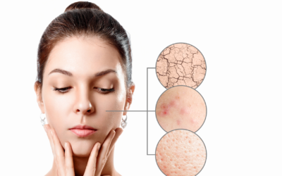 Pielęgnacja skóry podczas kuracji izotretynoiną