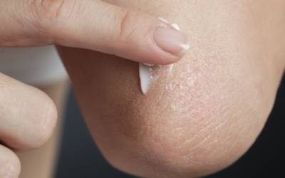 Kseroza – objawy, przyczyny, pielęgnacja skóry