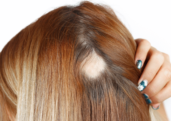 łysienie plackowate a stres
