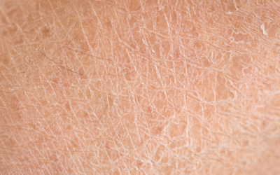Skóra sucha – przyczyny, objawy i pielęgnacja