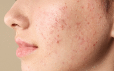Najlepsze kremy na trądzik – skuteczne kremy przeciwtrądzikowe