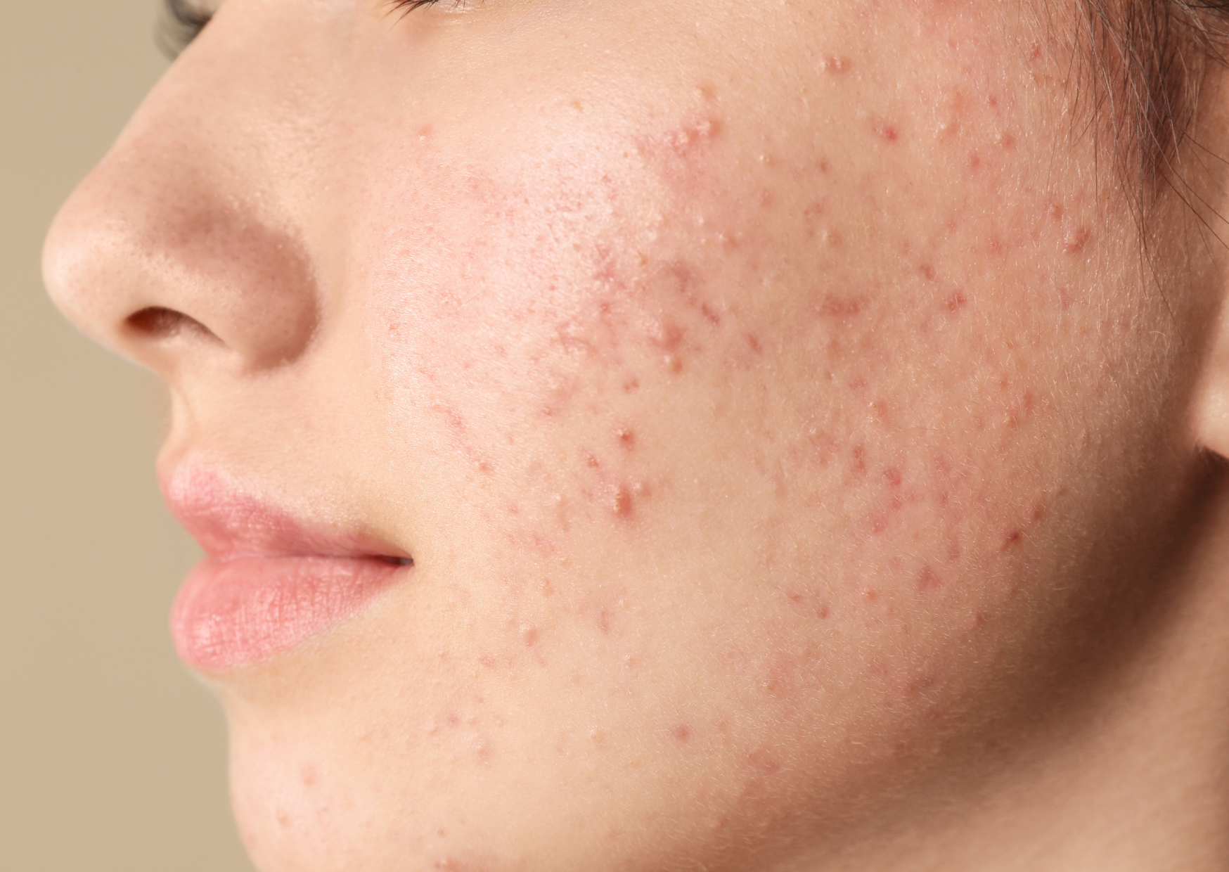 Projekt bez nazwy (7) kremy na trądzik