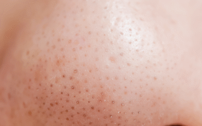 Zaskórniki zamknięte i otwarte – jak je usunąć?