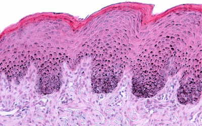 Zwiększone rogowacenie naskórka – częsty problem zimą i jego skutki