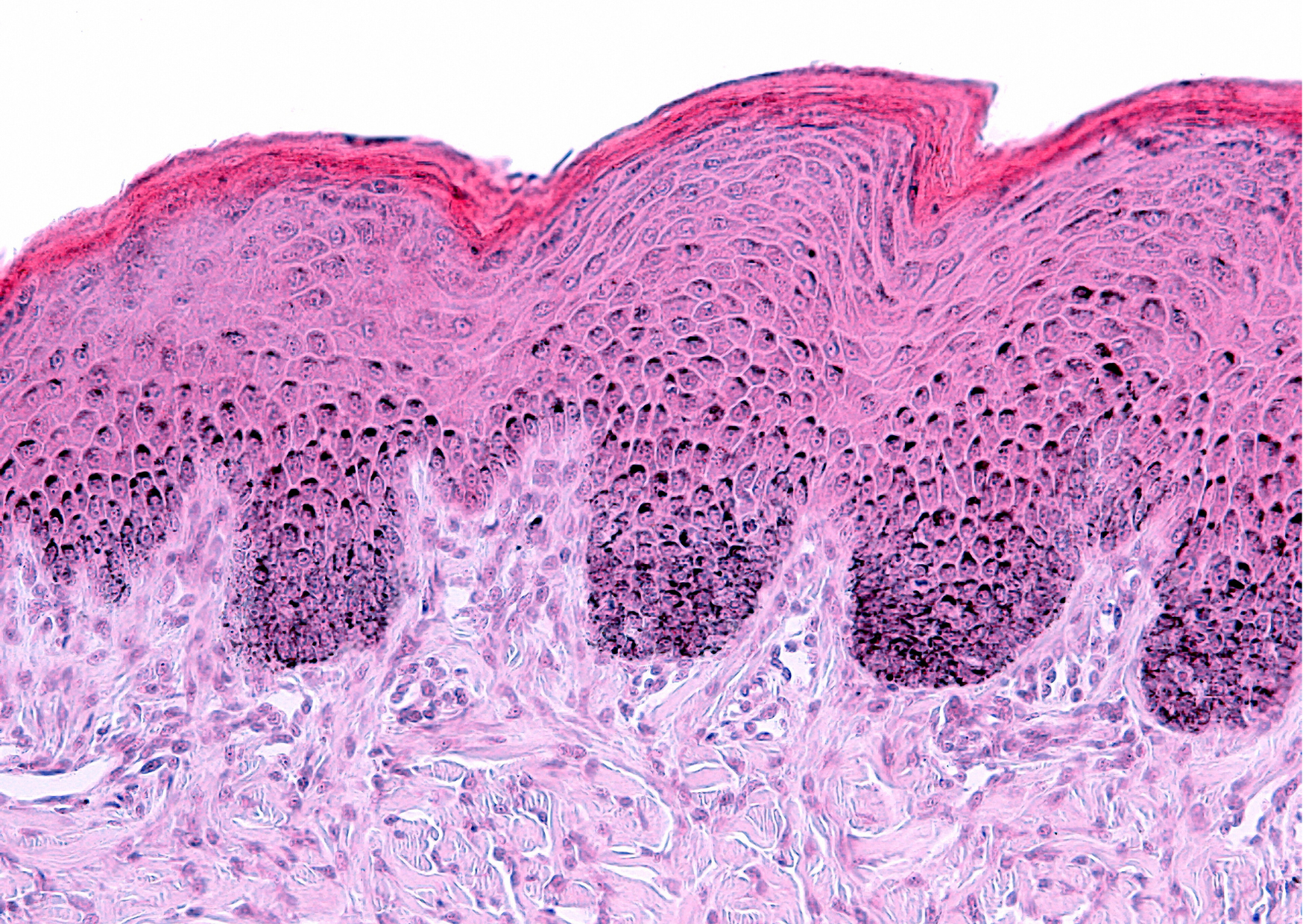 Projekt bez nazwy (7) rogowacenie naskórka