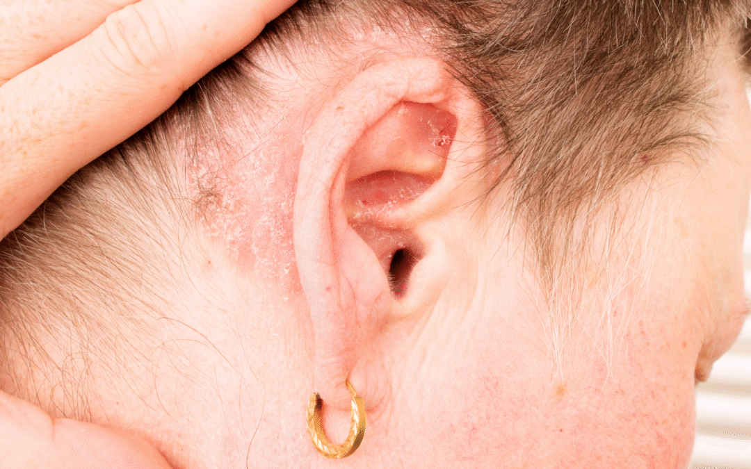 ŁZS – łojotokowe zapalenie skóry – przyczyny, objawy, pielęgnacja