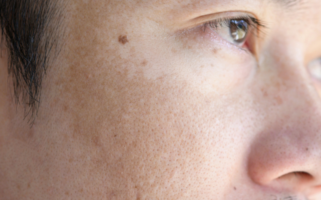 Przyczyny melasmy i sprawdzone sposoby postępowania