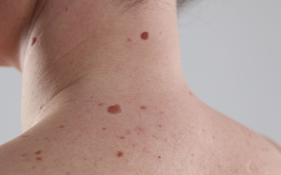 Brązowe zmiany na skórze – czy są groźne?