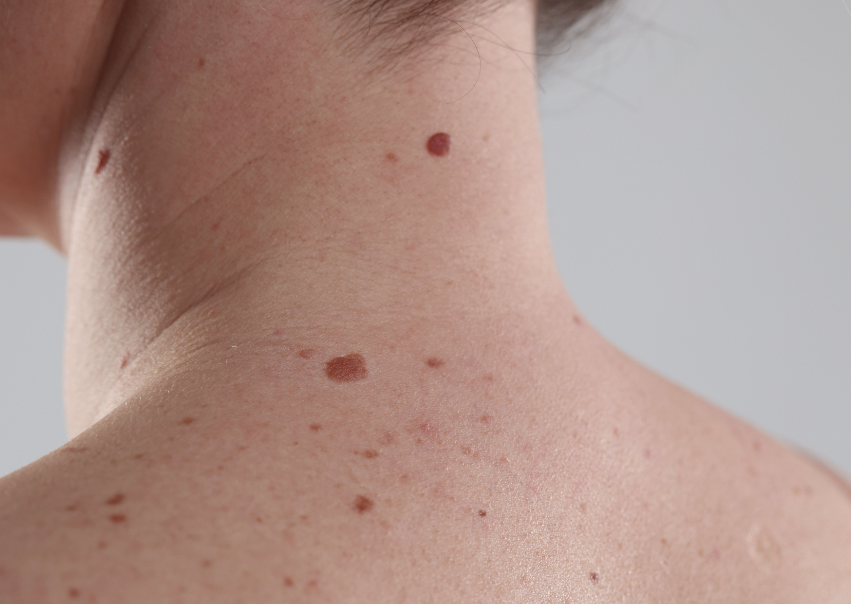 brązowe zmiany na skórze