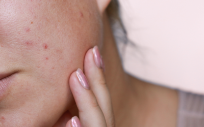 Wypryski na twarzy wiosną – jak ograniczyć ich powstawanie?